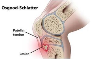 MORBO DI OSGOOD-SCHLATTER