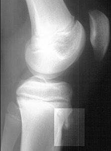 MORBO DI OSGOOD-SCHLATTER
