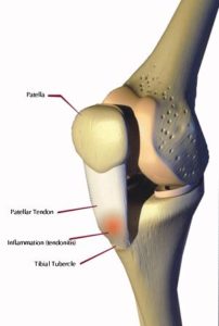 MORBO DI OSGOOD-SCHLATTER