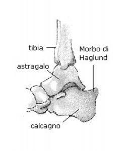 MORBO DI HAGLUND