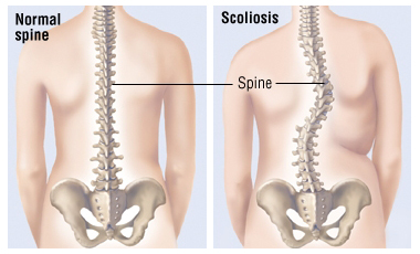 Studio SportHealth - Scoliosi